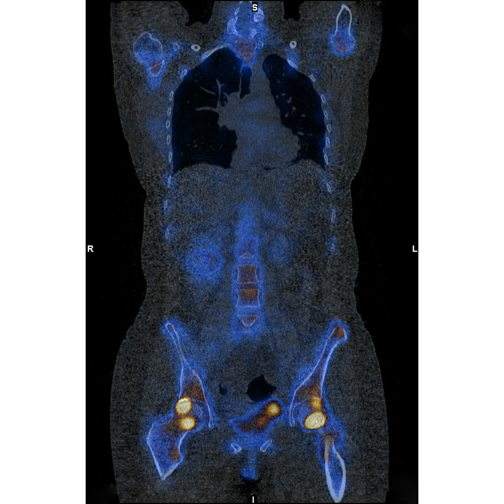 Skelettszintigraphie einer betroffenen Patientin mit Osteomalazie in den Hüften (gelb) nach intravenöser Eisentherapie mit Eisencarboxymaltose. © Universitätsklinik für Nuklearmedizin Innsbruck