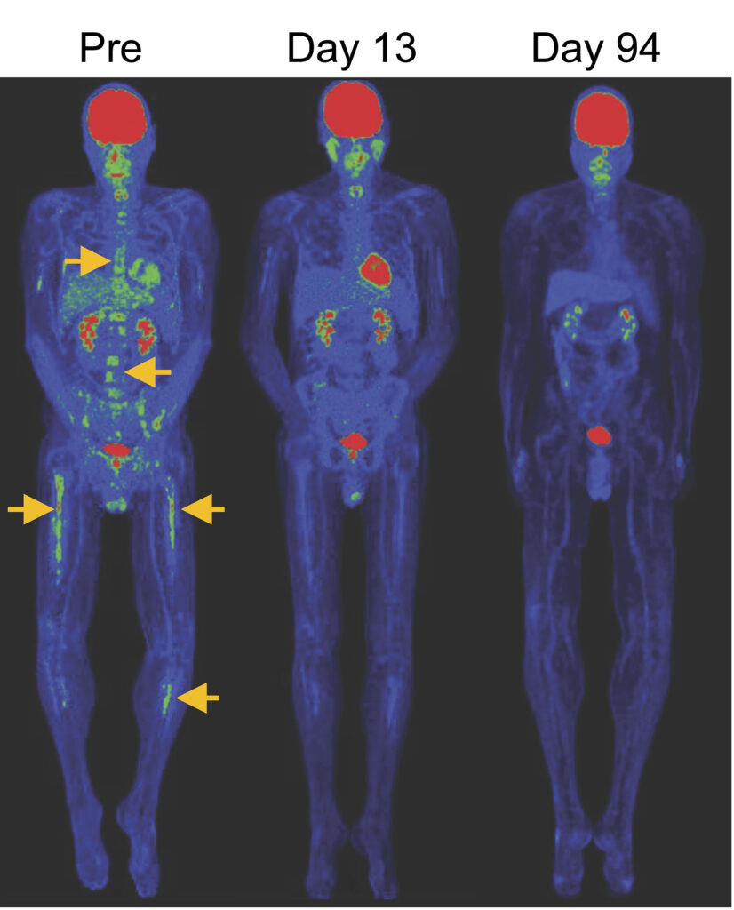 PET/CT-Aufnahmen zeigen die Rückbildung von Knochenläsionen bei B-Zell-ALL nach Behandlung mit CAR-TSCM-Zellen; gelbe Pfeile markieren die betroffenen Stellen.