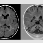 Forscher suchen die Ursache einer seltenen Erkrankung, die mit geistiger Behinderung und Hirnfehlbildungen einhergeht. Hirnscans eines Patienten mit dieser Erkrankung zeigen atypische Merkmale in der weißen Substanz (Pfeile, links) und im Kleinhirn (Pfeile, rechts). © RWTH Aachen