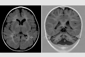 Forscher suchen die Ursache einer seltenen Erkrankung, die mit geistiger Behinderung und Hirnfehlbildungen einhergeht. Hirnscans eines Patienten mit dieser Erkrankung zeigen atypische Merkmale in der weißen Substanz (Pfeile, links) und im Kleinhirn (Pfeile, rechts). © RWTH Aachen