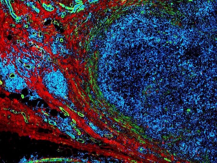 Brusttumor (blau) wächst im umliegenden Gewebe (rot), während sich Lymphgefäße (grün) als feines Netzwerk um ihn legen. © Jennifer Munson/Virginia Tech