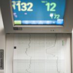 KI erkennt beginnenden Bluthochdruck im EKG