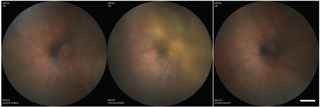 Bei den Versuchsmäusen zeigten sich Verbesserungen des Sehvermögens. Abgebildet der Zustand vor, direkt nach und 28 Tage nach der Injektion. (v.l.n.r.) © Nie et al., ACS Nano, 2025