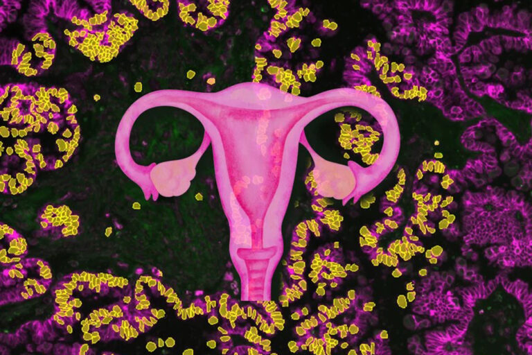 Neuer Therapieansatz für chemoresistenten Eierstockkrebs