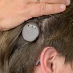Smartes Cochlea-Implantat hilft, wenn Hörgeräte versagen