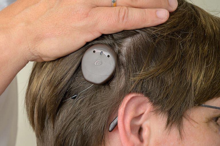 Smartes Cochlea-Implantat hilft, wenn Hörgeräte versagen