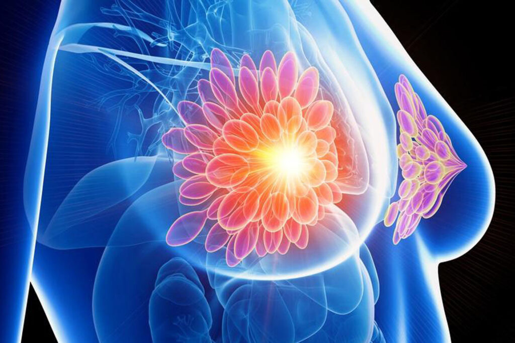 Experten: Zahlen zum Mammographie-Screening irreführend