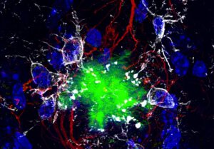 Tödliche Allianz im Gehirn: Der Alzheimer-Todeskomplex aus zwei Proteinen bringt Nervenzellen aus dem Gleichgewicht und beschleunigt die Krankheit.
