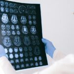Forscher beobachten Alzheimer-Plaques im lebenden Gehirn