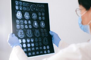 Forscher beobachten Alzheimer-Plaques im lebenden Gehirn