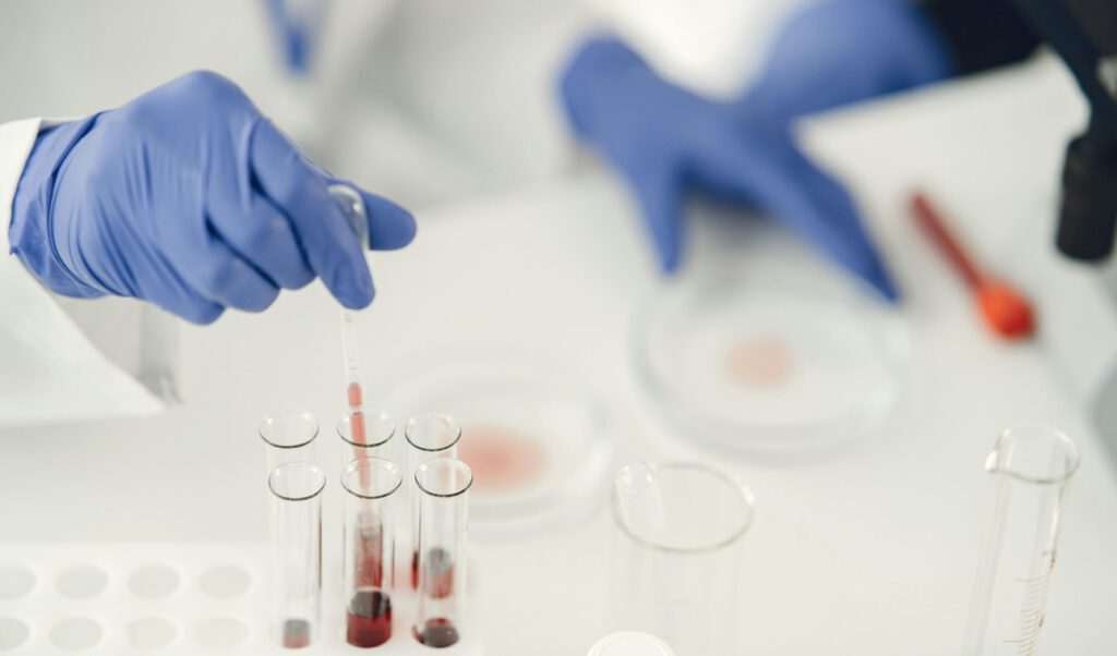 Bluttest erkennt Tumor-DNA und findet Krebs, den Ärzte übersehen