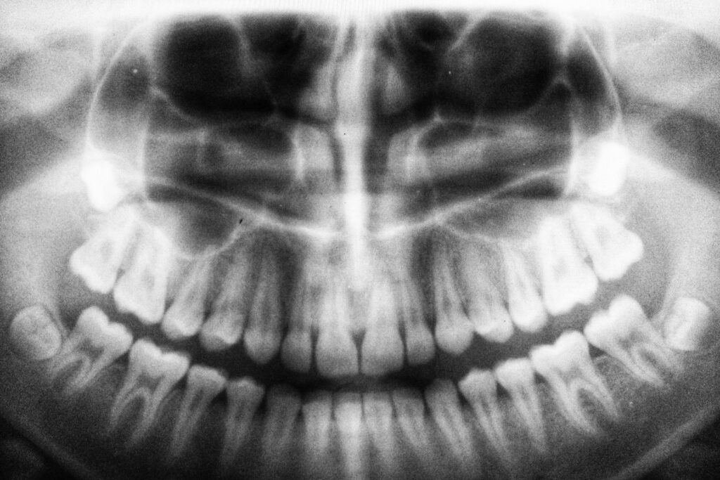 Studie: Schneller Zahnverlust im Alter senkt die Lebenserwartung