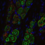 Nasentropfen gegen Hirntumor – Neuer Weg ins Gehirn entdeckt