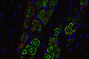 Nasentropfen gegen Hirntumor – Neuer Weg ins Gehirn entdeckt