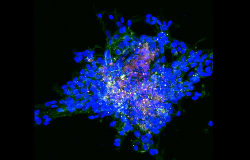 Brustkrebs unter dem Mikroskop