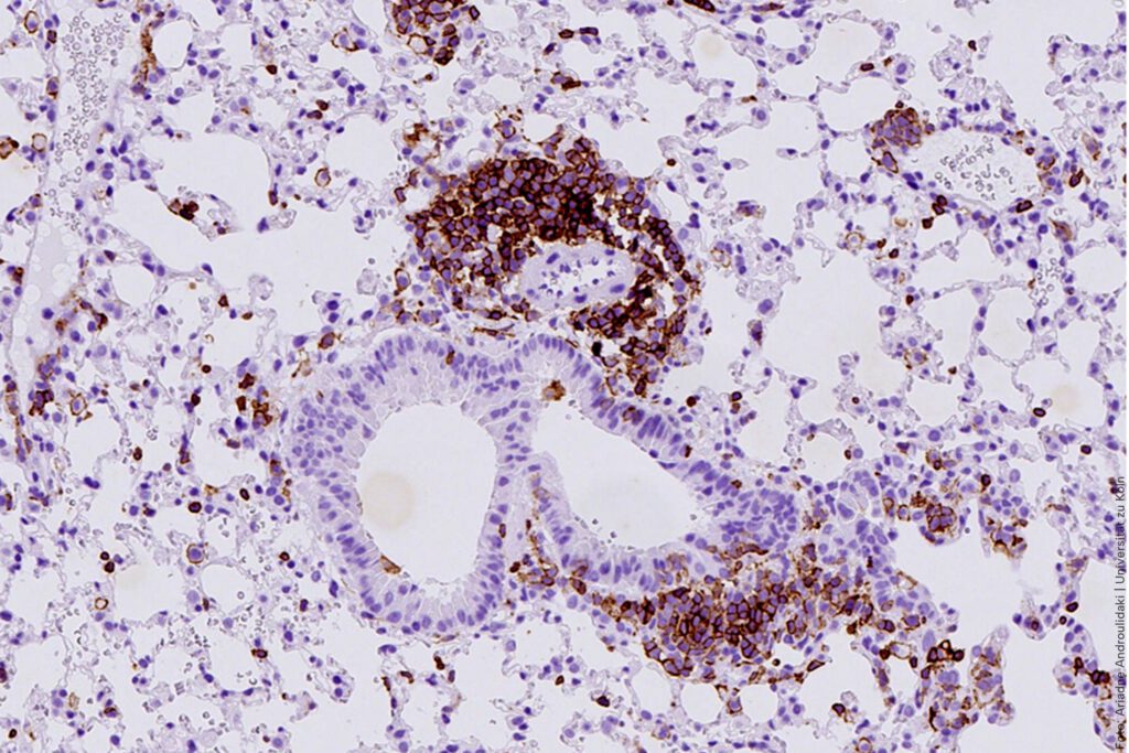 Die Abbildung zeigt Lungenalveolargewebe aus einem Mausmodell für kleinzelligen Lungenkrebs mit braun markierten Immunzellen