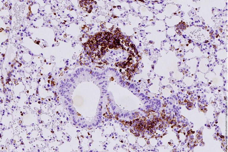 Die Abbildung zeigt Lungenalveolargewebe aus einem Mausmodell für kleinzelligen Lungenkrebs mit braun markierten Immunzellen
