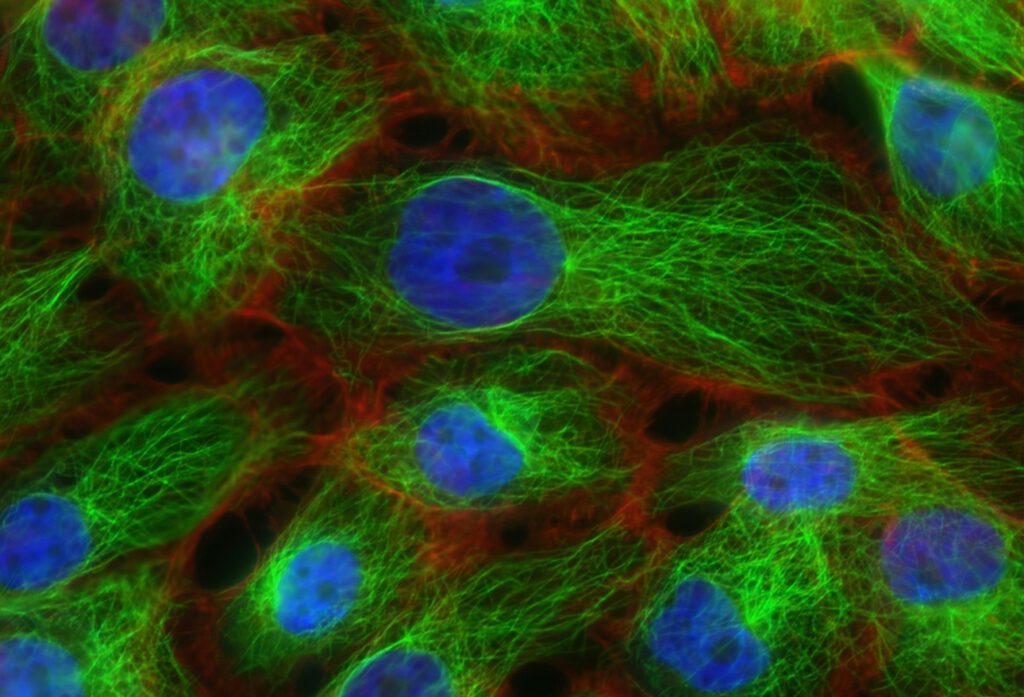 Krebszellen unter dem Mikroskop