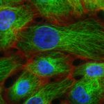 Krebszellen unter dem Mikroskop