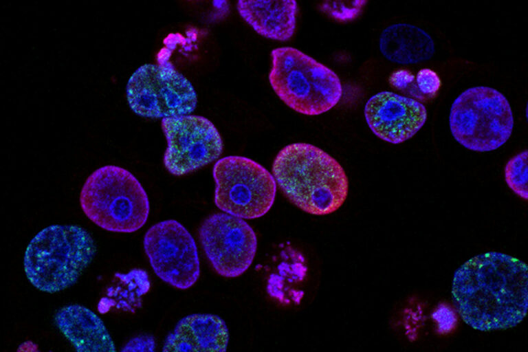 Krebszellen unter dem Mikroskop