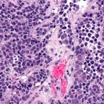 Blasenkrebs-Behandlung: Mini-Roboter bringen Chemo direkt in den Tumor