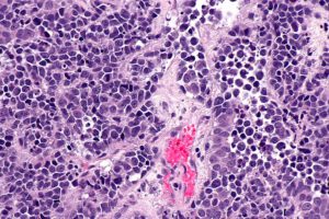 Winzige Mikroroboter aus Mikroalgen sollen Chemowirkstoffe gezielt zum Blasentumor bringen. Im Tierversuch drang das Medikament dadurch deutlich tiefer ins Tumorgewebe ein. © Nephron via Wikimedia Commons unter CC BY-SA 3.0
