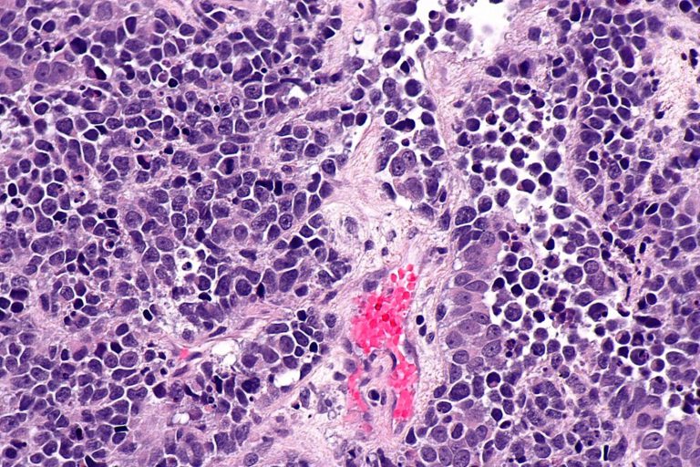 Winzige Mikroroboter aus Mikroalgen sollen Chemowirkstoffe gezielt zum Blasentumor bringen. Im Tierversuch drang das Medikament dadurch deutlich tiefer ins Tumorgewebe ein. © Nephron via Wikimedia Commons unter CC BY-SA 3.0