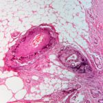 Darmkrebs gilt oft als Erkrankung älterer Menschen. Neue Daten zeigen jedoch, dass die Fälle bei jungen Erwachsenen zunehmen und viele Diagnosen erst spät gestellt werden. © Patho via Wikimedia Commons unter CC BY-SA 3.0