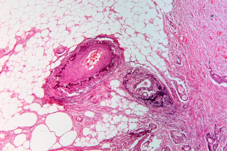 Darmkrebs gilt oft als Erkrankung älterer Menschen. Neue Daten zeigen jedoch, dass die Fälle bei jungen Erwachsenen zunehmen und viele Diagnosen erst spät gestellt werden. © Patho via Wikimedia Commons unter CC BY-SA 3.0