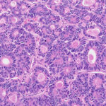 Darmkrebs unter 50 nimmt seit Jahren zu. Viele Fälle werden erst erkannt, wenn der Tumor bereits fortgeschritten ist.