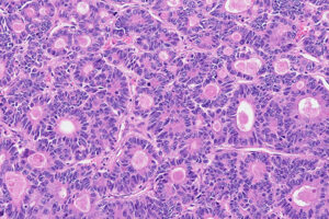 Darmkrebs unter 50 nimmt seit Jahren zu. Viele Fälle werden erst erkannt, wenn der Tumor bereits fortgeschritten ist.