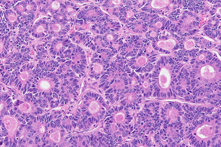 Darmkrebs unter 50 nimmt seit Jahren zu. Viele Fälle werden erst erkannt, wenn der Tumor bereits fortgeschritten ist.