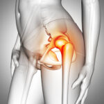 Gerade an der Hüfte müssen Implantate besonders fest einheilen. Eine neue Beschichtung mit Kurkuma und Ingwer soll dabei helfen. © Freepik