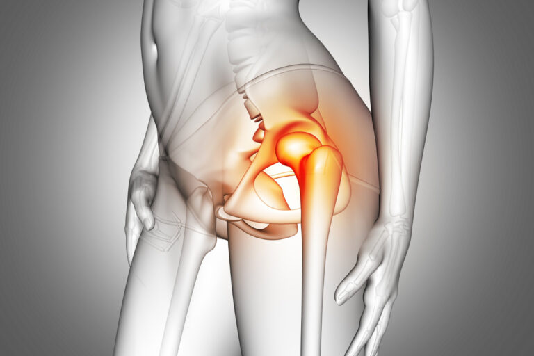 Gerade an der Hüfte müssen Implantate besonders fest einheilen. Eine neue Beschichtung mit Kurkuma und Ingwer soll dabei helfen. © Freepik