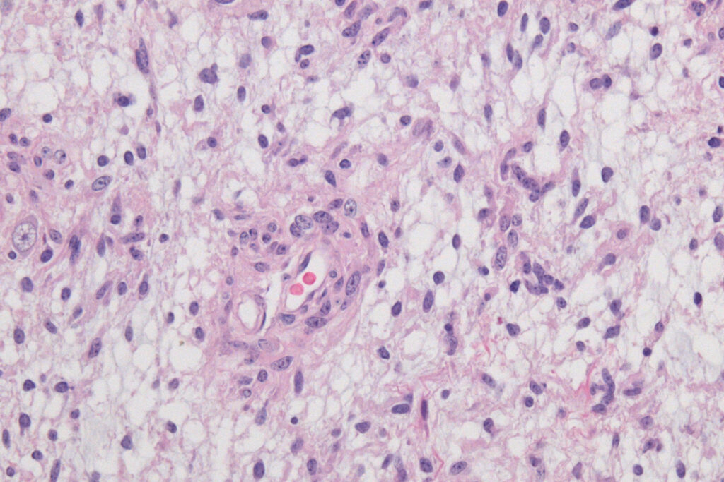 Die KI Hetairos analysiert gewöhnliche Gewebeschnitte aus der Pathologie. Aus den Zellmustern kann sie Hinweise auf mehr als 100 Hirntumor-Untergruppen ableiten. © Wikimedia