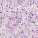 Die KI Hetairos analysiert gewöhnliche Gewebeschnitte aus der Pathologie. Aus den Zellmustern kann sie Hinweise auf mehr als 100 Hirntumor-Untergruppen ableiten. © Wikimedia