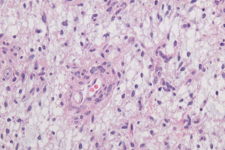 Die KI Hetairos analysiert gewöhnliche Gewebeschnitte aus der Pathologie. Aus den Zellmustern kann sie Hinweise auf mehr als 100 Hirntumor-Untergruppen ableiten. © Wikimedia