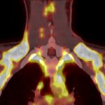 Nach Kälte nahm braunes Fett rund 30-mal mehr markierte Glukose auf als nach der Behandlung mit Fenoterol. © Matthias Betz, Universität Basel, Universitätsspital Basel