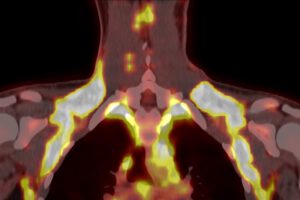 Nach Kälte nahm braunes Fett rund 30-mal mehr markierte Glukose auf als nach der Behandlung mit Fenoterol. © Matthias Betz, Universität Basel, Universitätsspital Basel