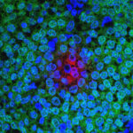 Brustkrebs mit Therapieresistenz