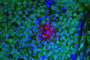 Brustkrebs mit Therapieresistenz