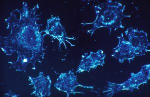 Unter anhaltendem mechanischem Druck können Krebszellen ihre Beweglichkeit verlieren und schließlich absterben. Manche Tumorzellen entkommen diesem Schutzmechanismus und können sich weiter im Körper ausbreiten.