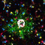 Verschiedene Protein-Marker im Hirngewebeschnitt eines Patienten mit Alzheimer-Erkrankung. © Universität Augsburg, modifiziert nach Rosmus et al., Nature Neuroscience, 2026