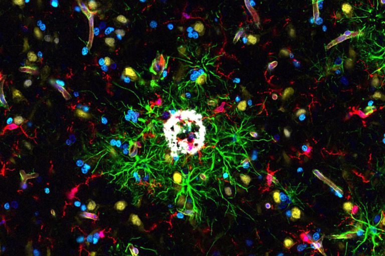 Verschiedene Protein-Marker im Hirngewebeschnitt eines Patienten mit Alzheimer-Erkrankung. © Universität Augsburg, modifiziert nach Rosmus et al., Nature Neuroscience, 2026