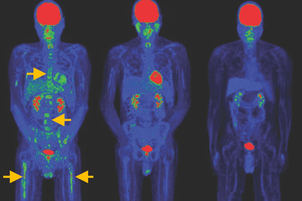 Die Bilder zeigen, wie sich Tumore nach der Behandlung mit speziellen CAR-T-Zellen deutlich zurückbildeten – und das sogar ohne vorbereitende Chemotherapie.