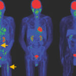 Die Bilder zeigen, wie sich Tumore nach der Behandlung mit speziellen CAR-T-Zellen deutlich zurückbildeten – und das sogar ohne vorbereitende Chemotherapie.