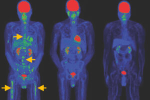 Die Bilder zeigen, wie sich Tumore nach der Behandlung mit speziellen CAR-T-Zellen deutlich zurückbildeten – und das sogar ohne vorbereitende Chemotherapie.