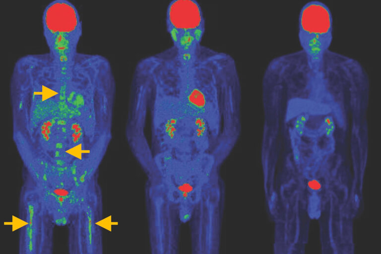 Die Bilder zeigen, wie sich Tumore nach der Behandlung mit speziellen CAR-T-Zellen deutlich zurückbildeten – und das sogar ohne vorbereitende Chemotherapie.