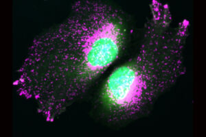 Das Mikroskopbild zeigt Zellen ohne das Protein TBC1D9B. Dadurch geraten die Lysosomen aus ihrer Ordnung, was den Zellstress erhöhen kann. © Klaudia Kosieradzka, FMP, Berlin