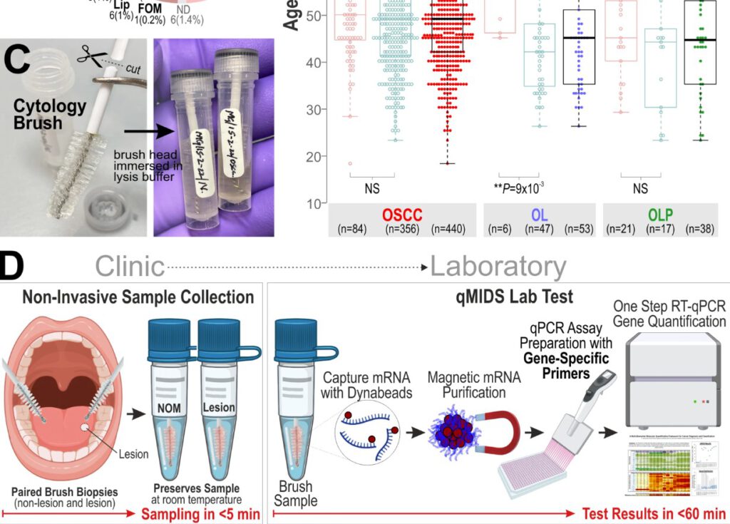 Die Grafik aus der Studie zeigt den Ablauf des Bürstentests: Ärzte streichen über eine verdächtige Stelle im Mund, danach wird die Probe auf typische Krebs-Signale untersucht. © Teh et al. / Biomarker Research (2026), (CC BY 4.0)